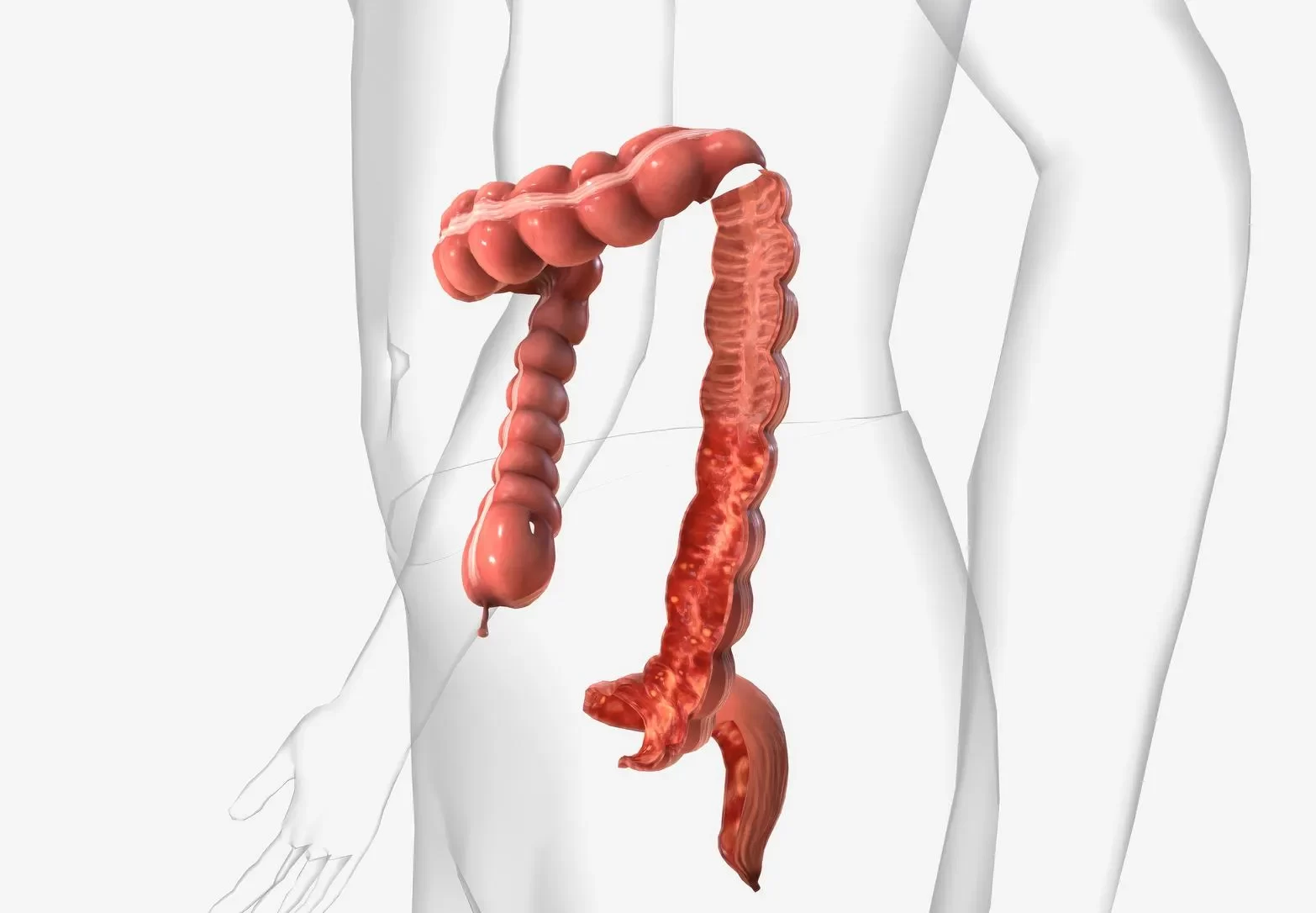 Ilustración médica de colitis