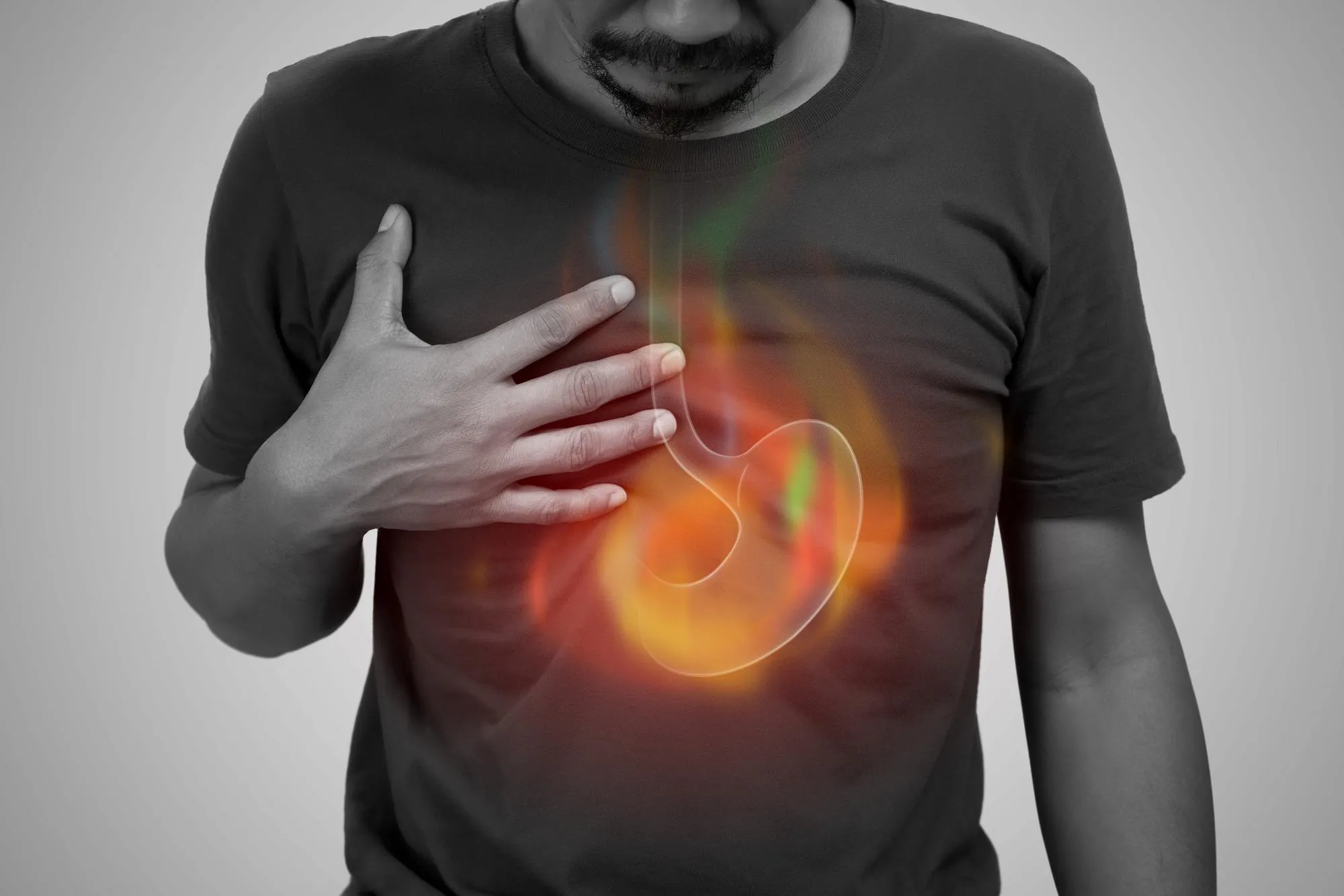 Ilustración médica de reflujo gastroesofágico