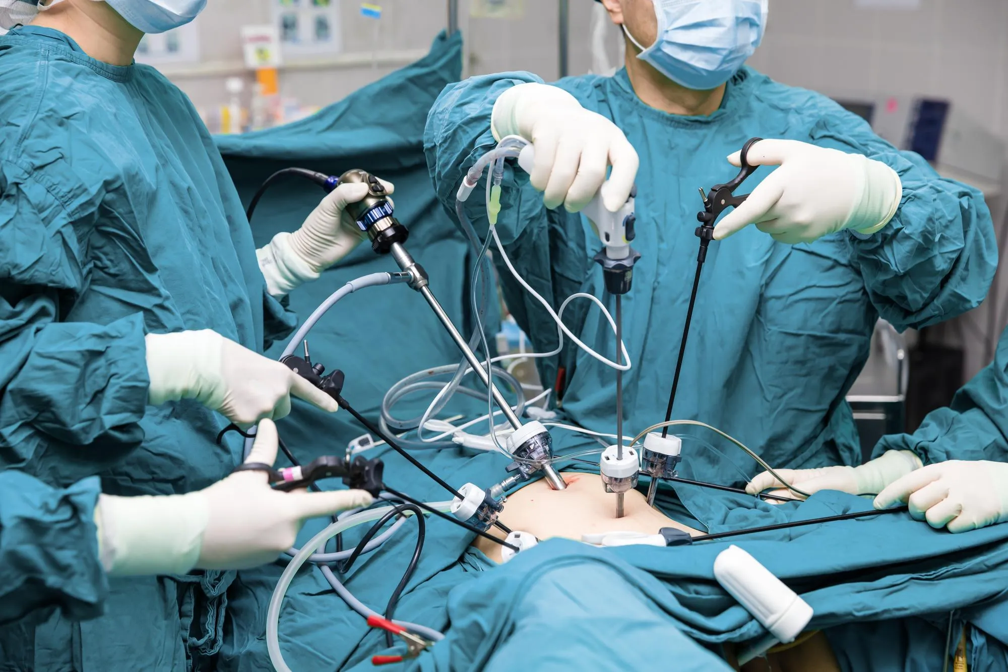 Cirugía laparoscópica de reflujo y hernia hiatal