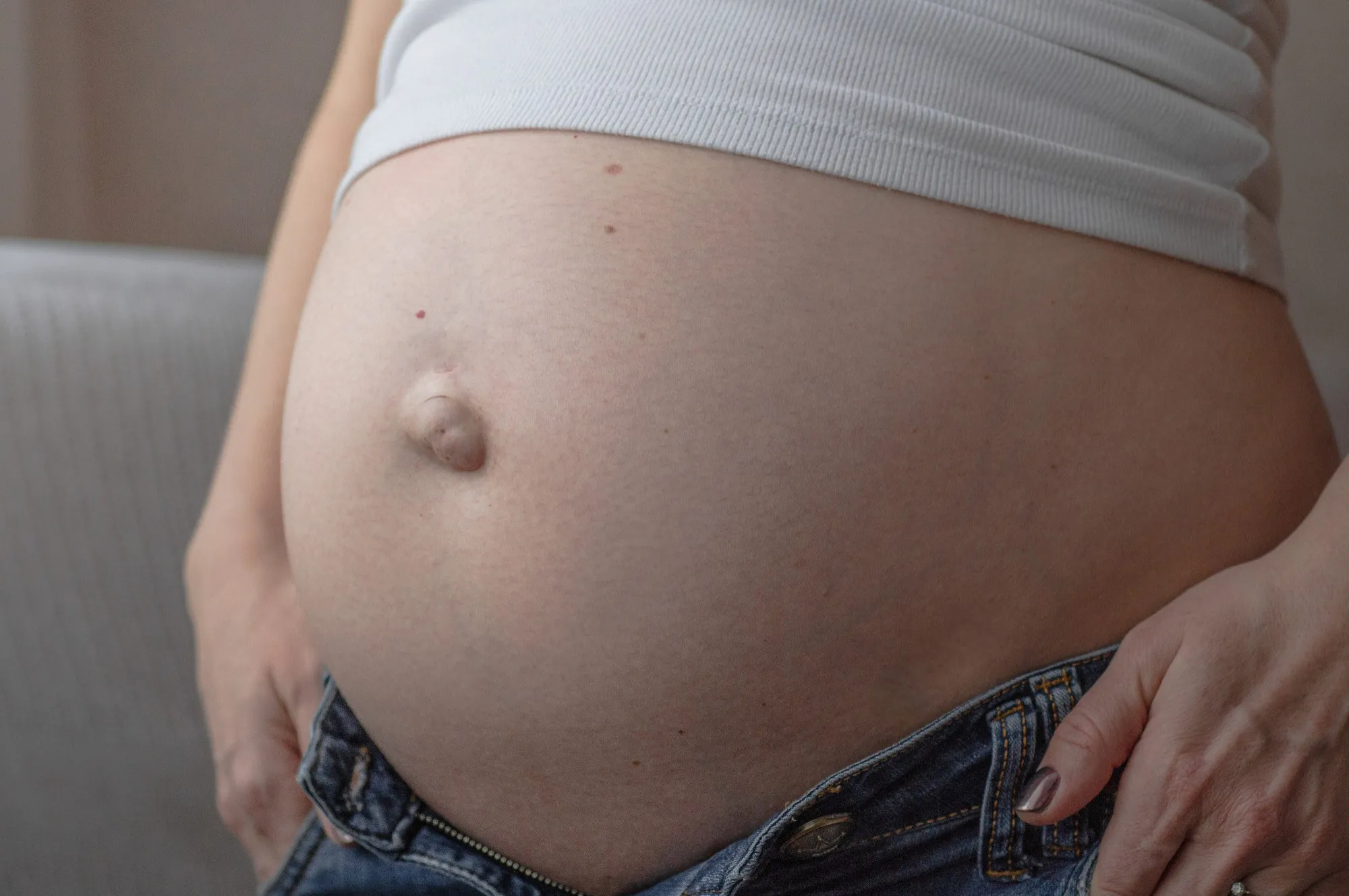 Cirugía de hernia umbilical